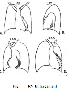 580_Right Ventricle Enlargement.png